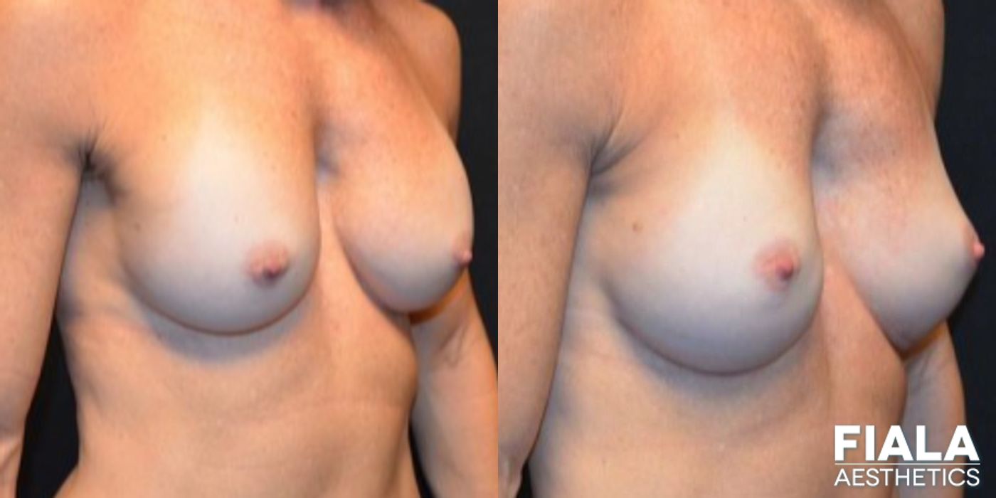 Before and after Breast Revision case 14005 - Angle 2