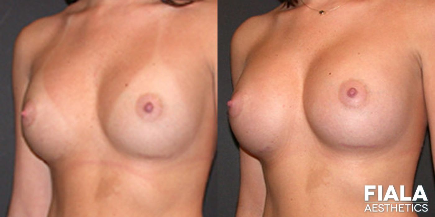 Before and after Breast Revision case 13788 - Angle 2
