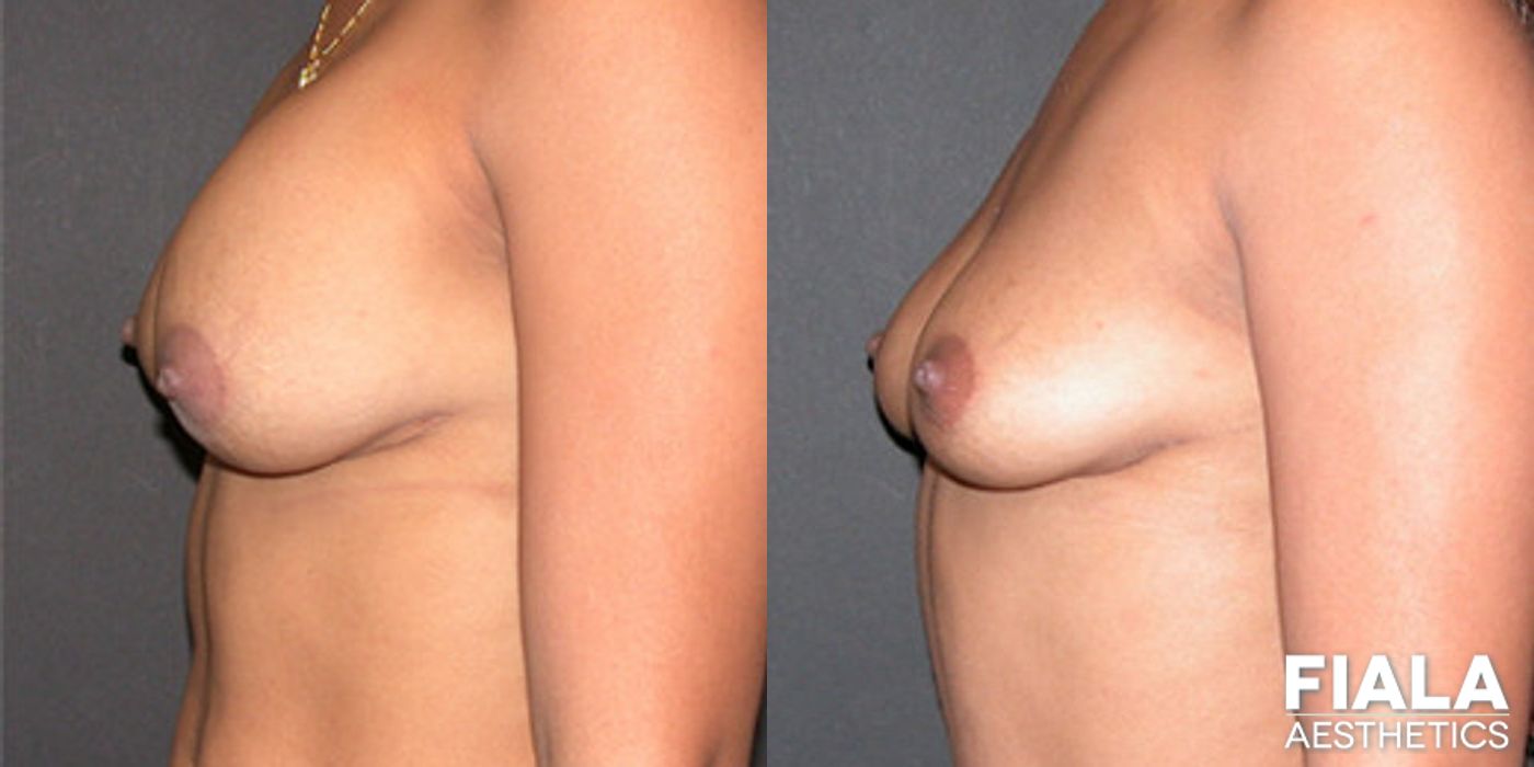 Before and after Breast Revision case 13782 - Angle 2