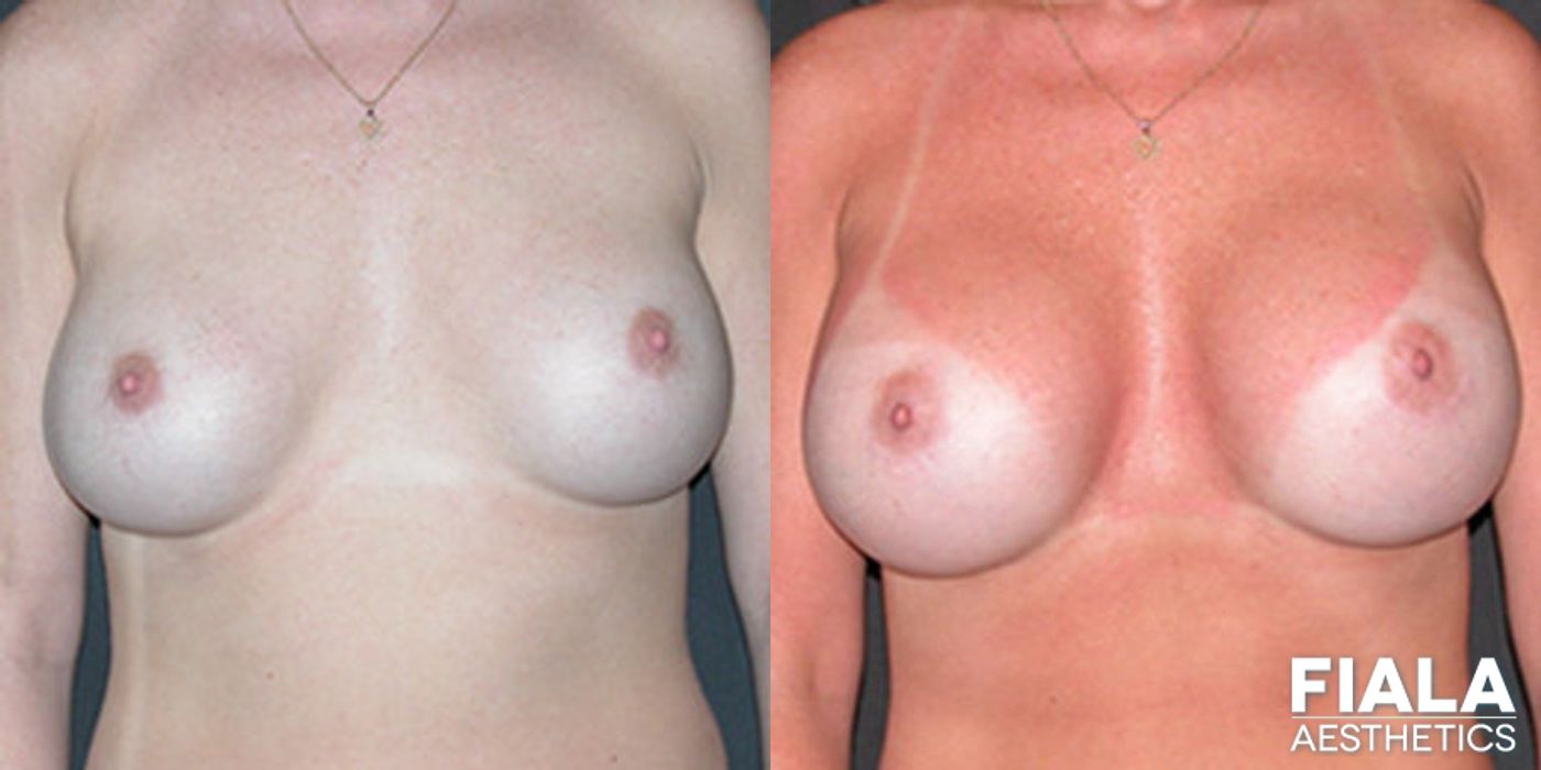 Before and after Breast Revision case 13790
