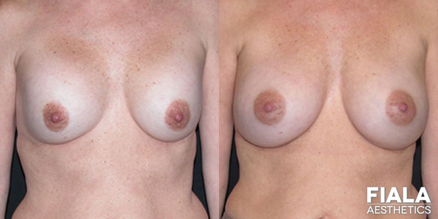 Before and after Breast Revision case 13785