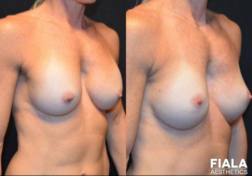 Breast Revision - Thumbnail 2