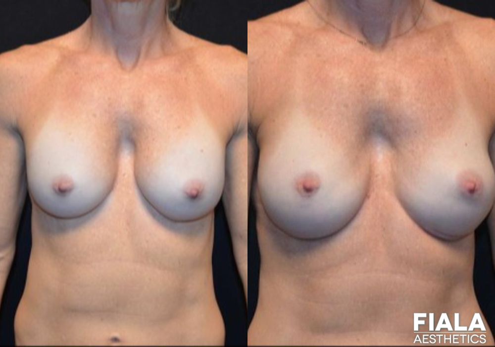 Breast Revision - Case 8993