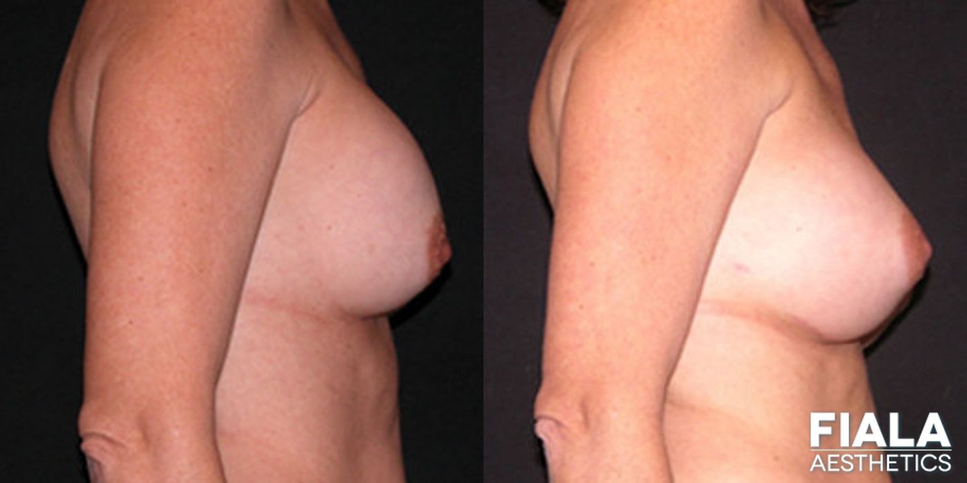 Before and after Breast Revision case 13785 - Angle 2