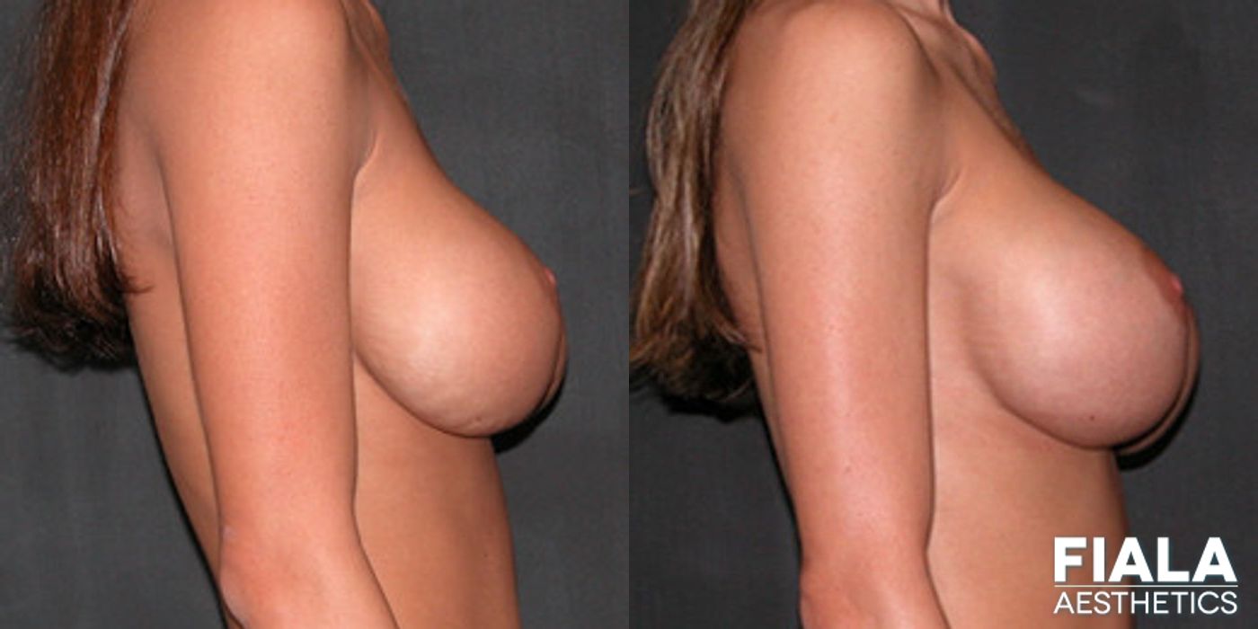 Before and after Breast Revision case 13776 - Angle 2
