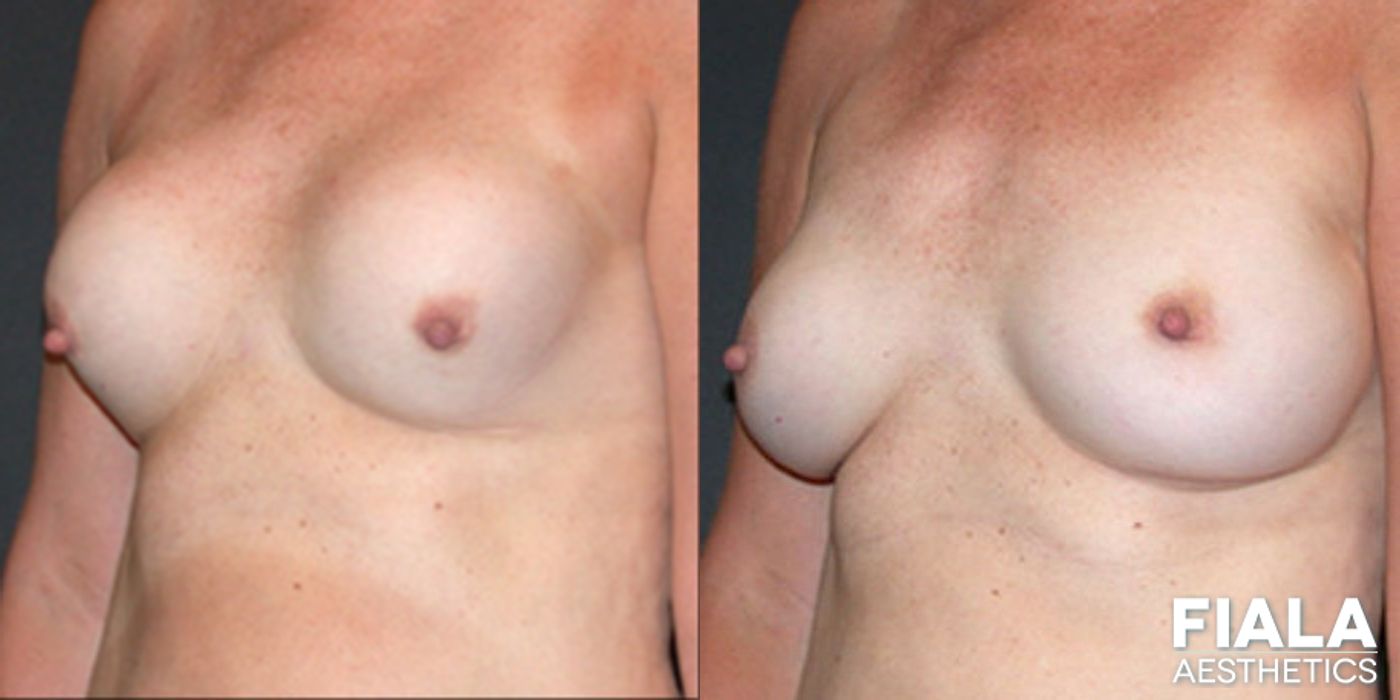 Before and after Breast Revision case 13783 - Angle 2