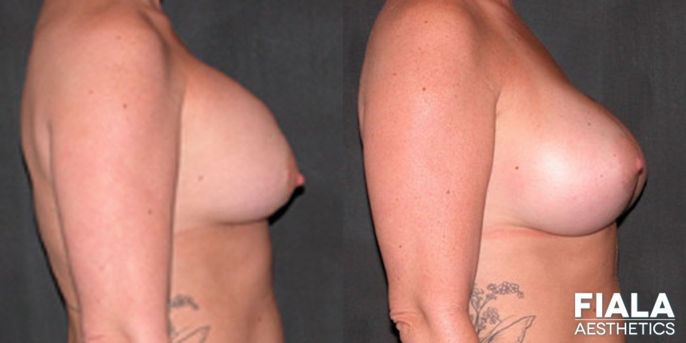 Before and after Breast Revision case 13784 - Angle 2