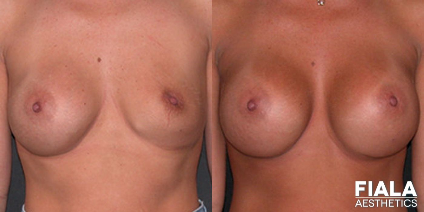 Before and after Breast Revision case 13792