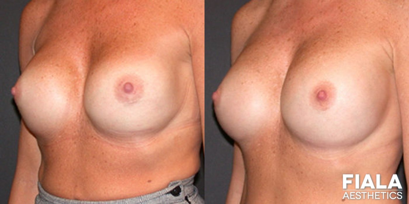 Before and after Breast Revision case 13767 - Angle 2
