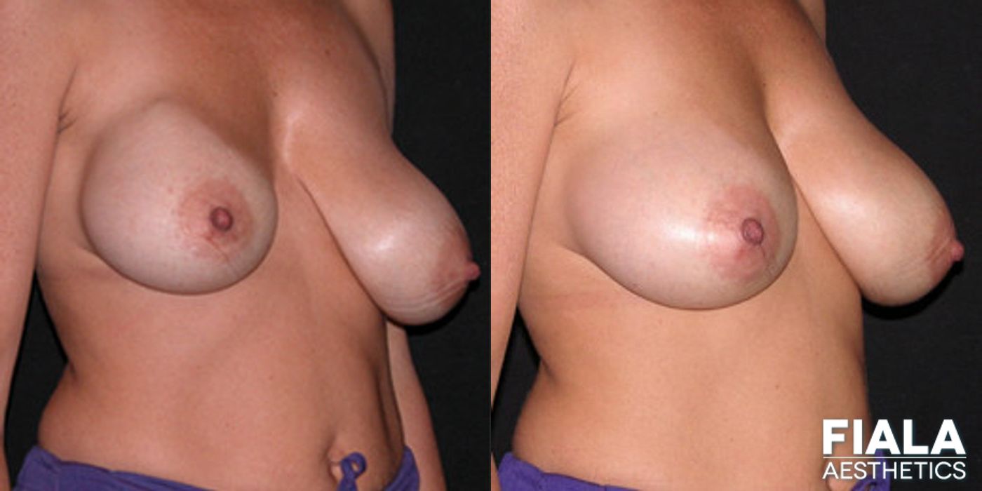 Before and after Breast Revision case 13774 - Angle 2