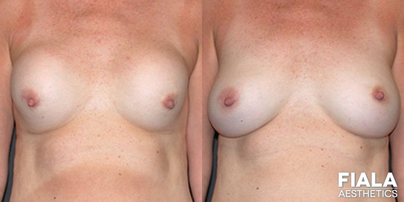 Before and after Breast Revision case 13783