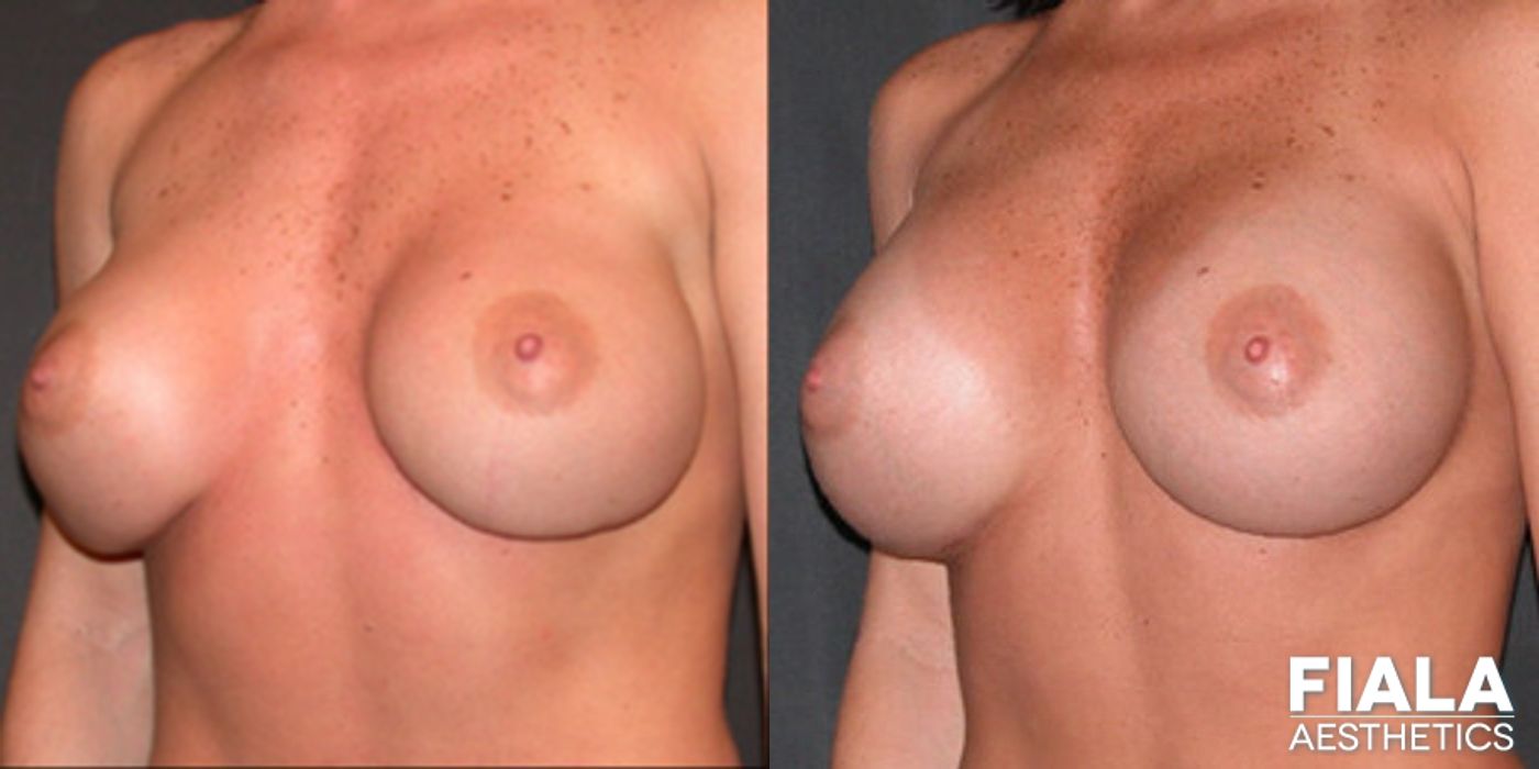 Before and after Breast Revision case 13778 - Angle 2