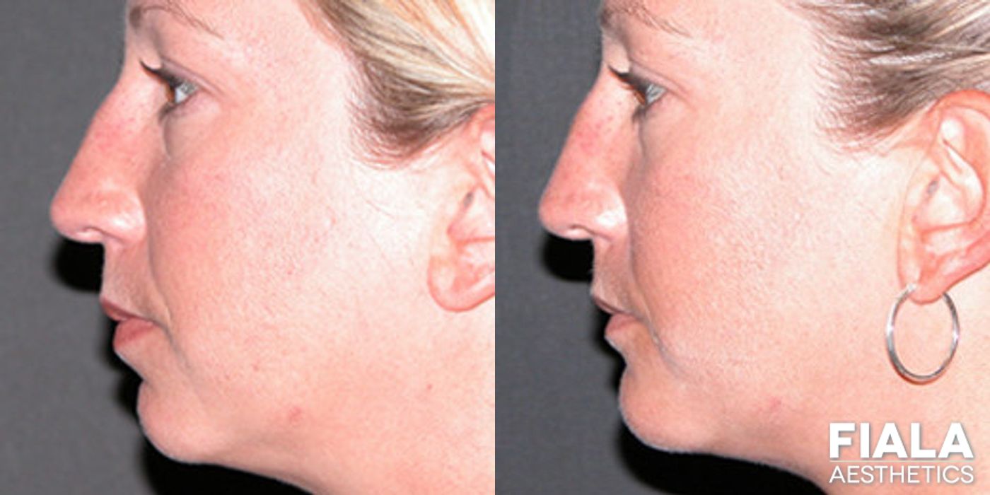 Before and after Chin and Neck case 13855
