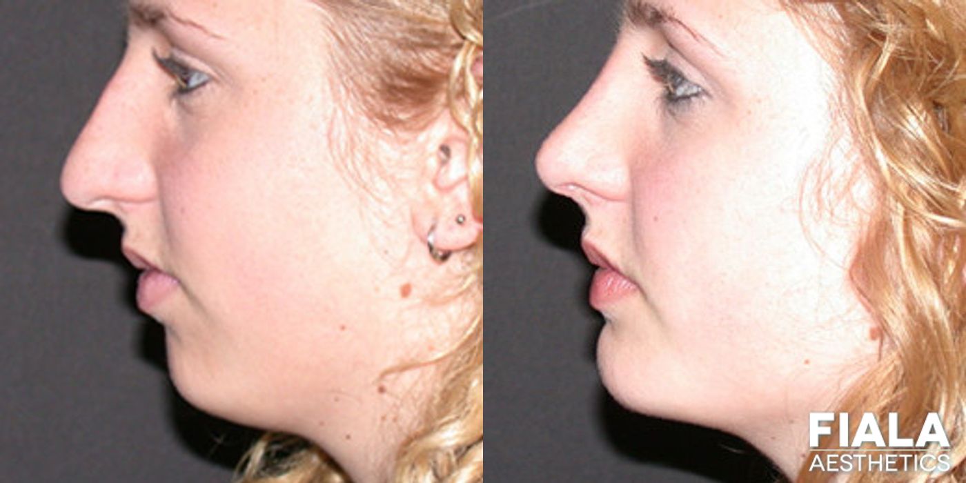 Before and after Chin and Neck case 13847