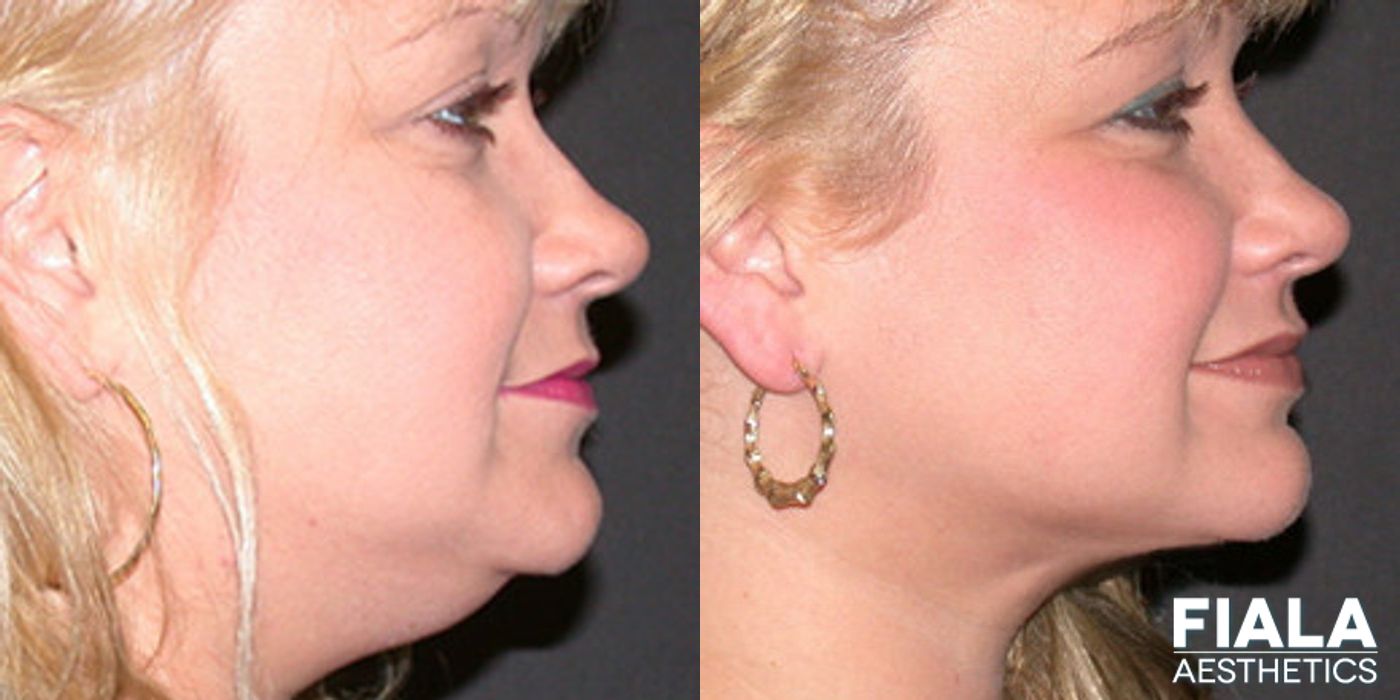 Before and after Chin and Neck case 13967 - Angle 2