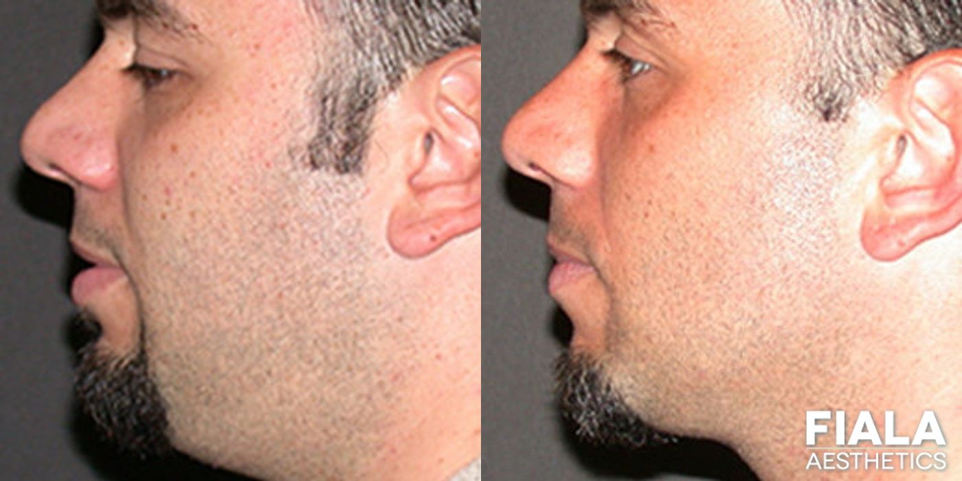 Before and after Chin and Neck case 13966