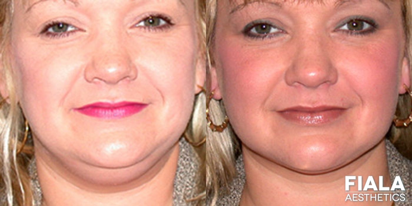 Before and after Chin and Neck case 13967