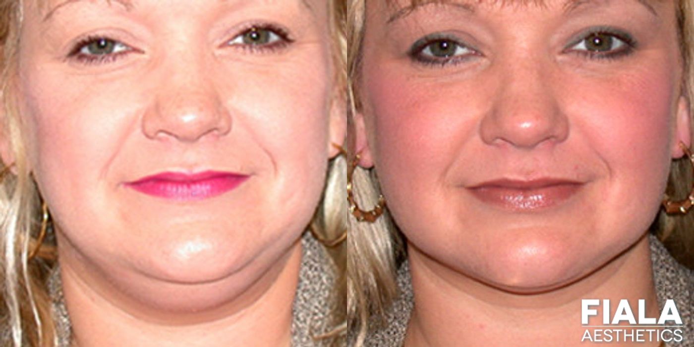 Chin and Neck - Thumbnail 2