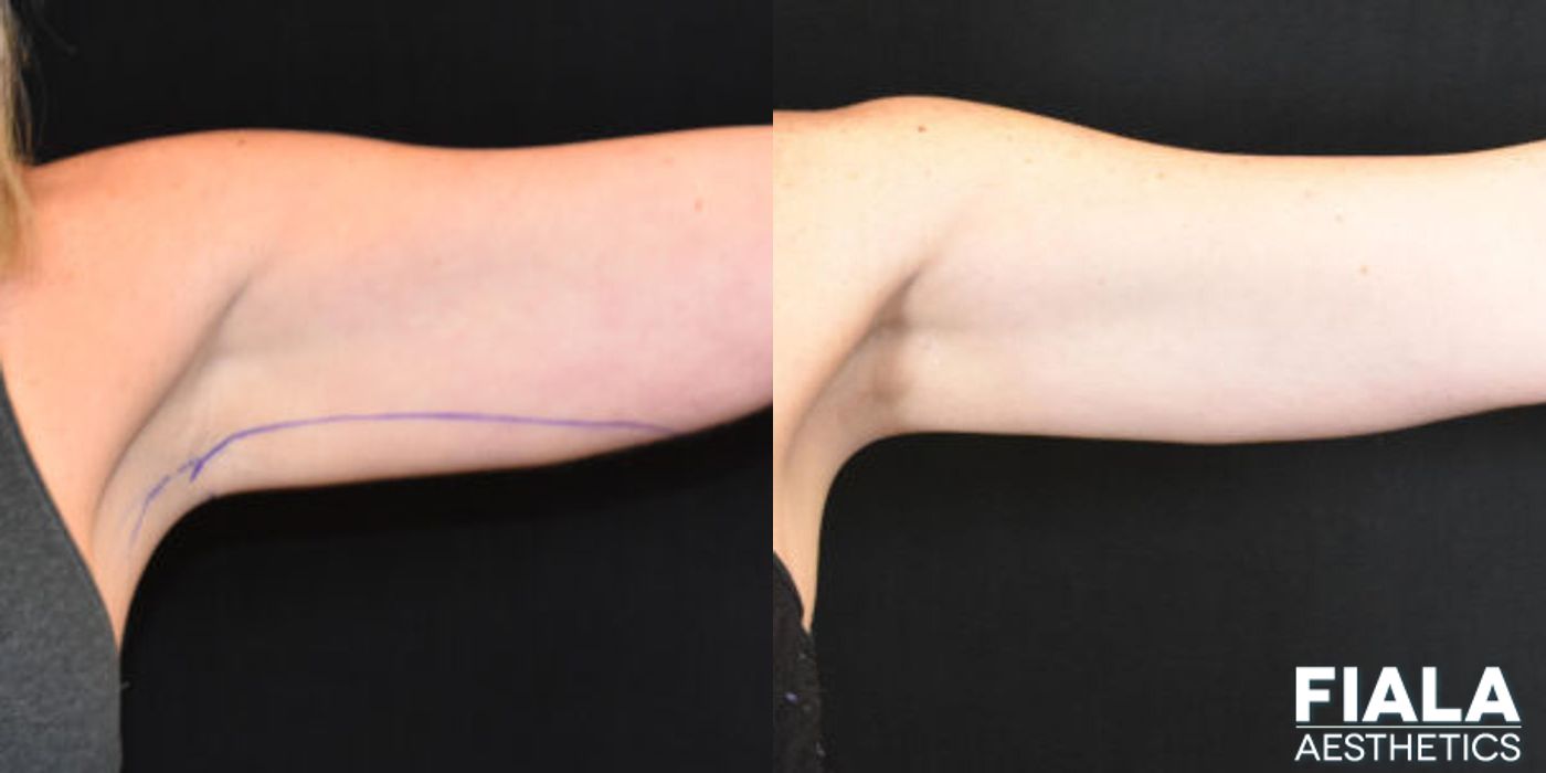 Coolsculpting - Case 9321