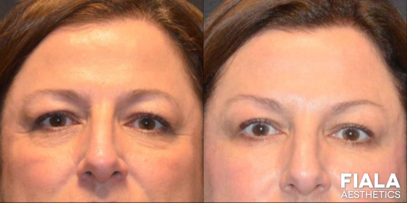 Before and after Dermal Fillers case 13933