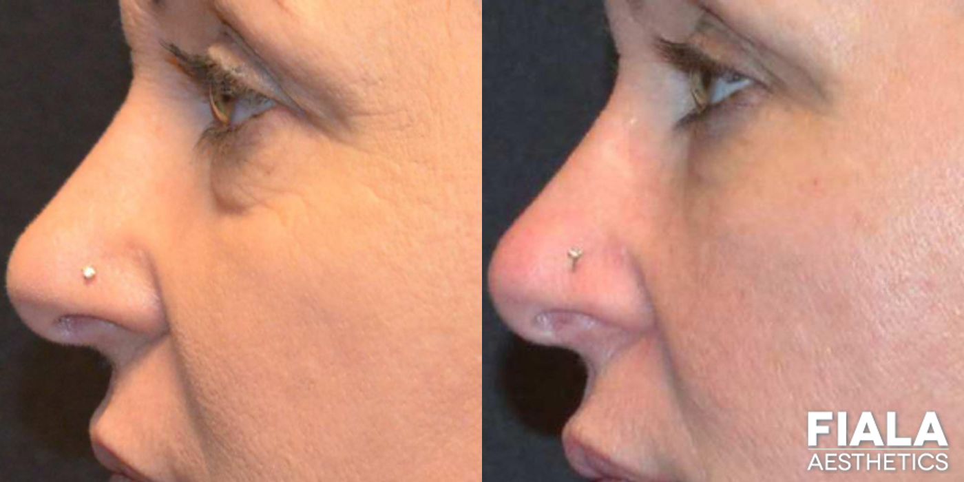 Before and after Dermal Fillers case 13936 - Angle 4
