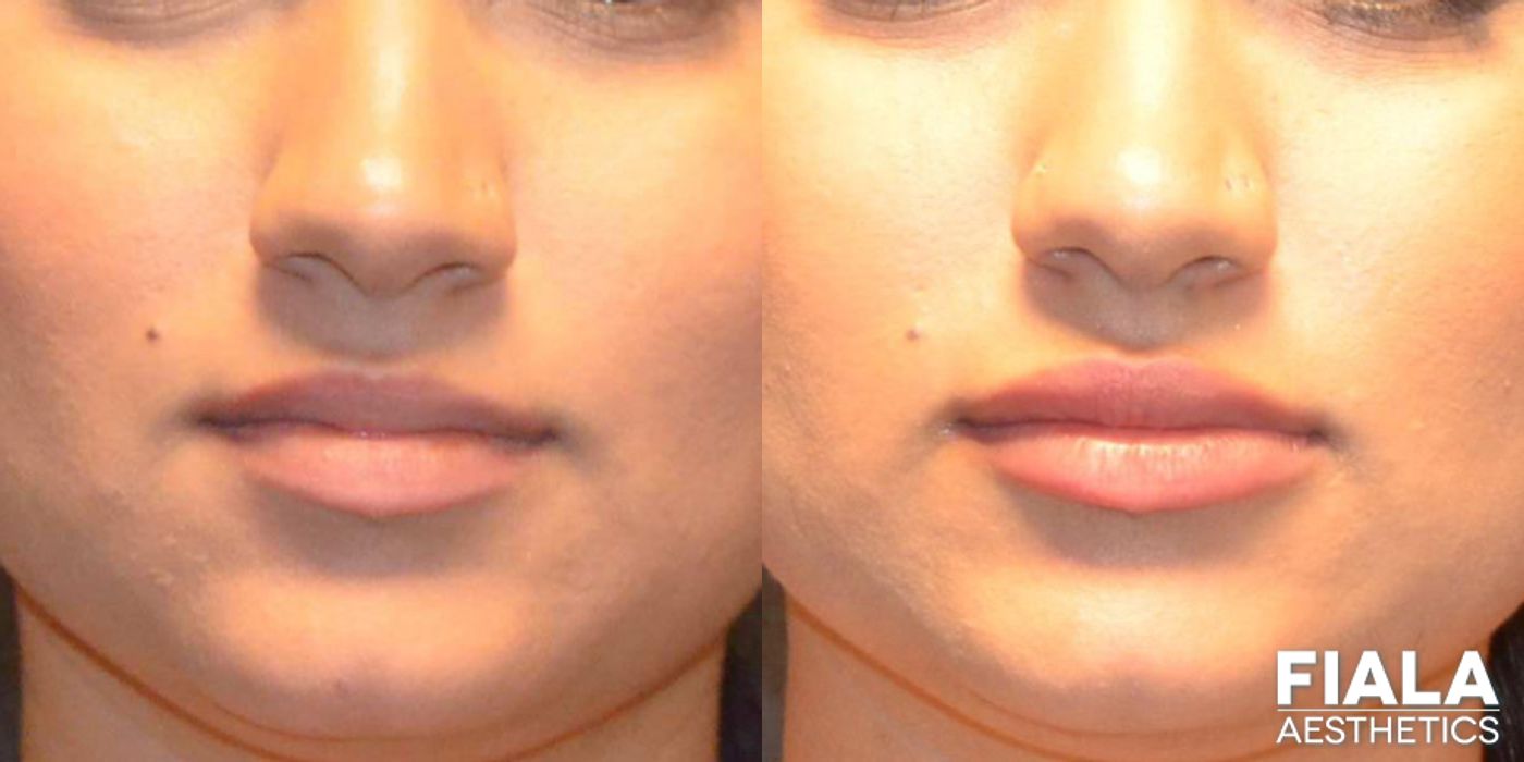 Before and after Dermal Fillers case 13941
