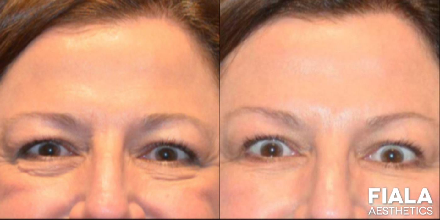 Before and after Dermal Fillers case 13933 - Angle 4