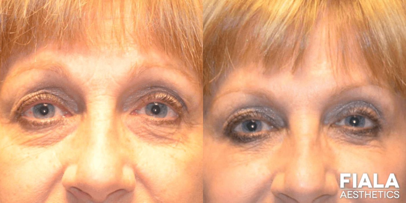 Before and after Dermal Fillers case 13932 - Angle 2