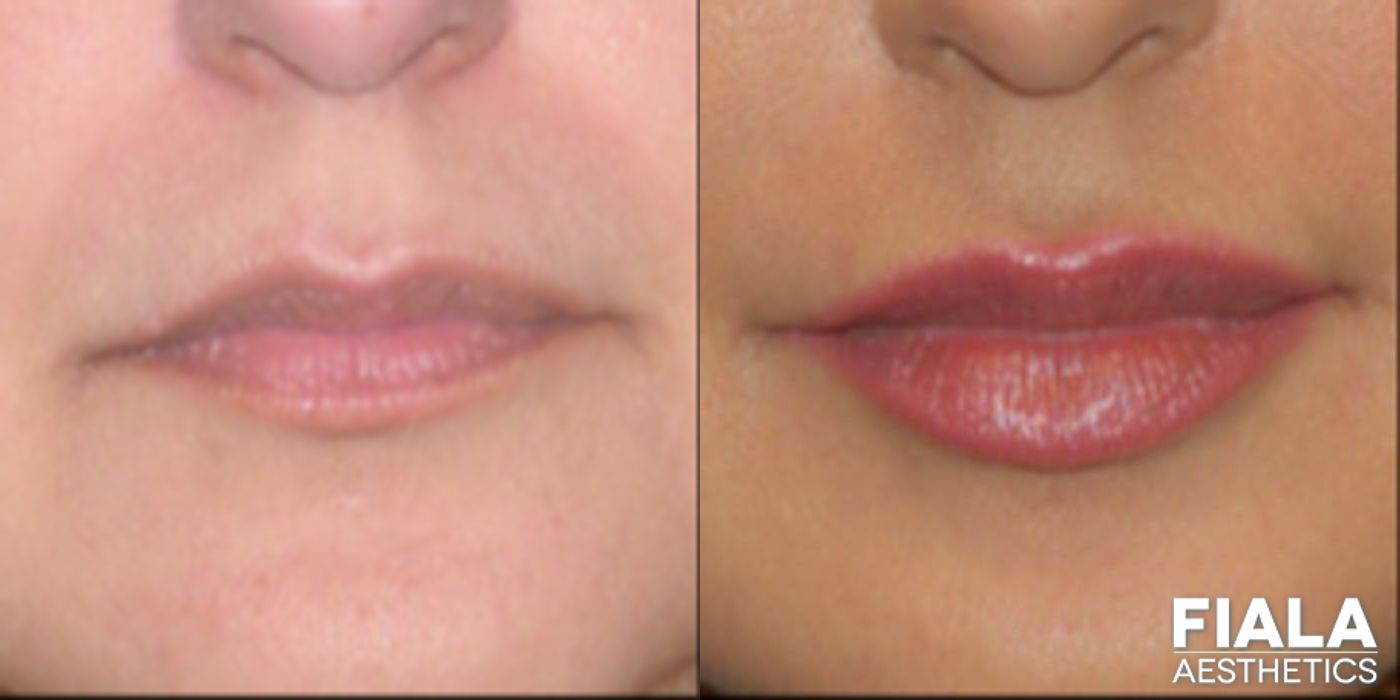 Before and after Dermal Fillers case 13925