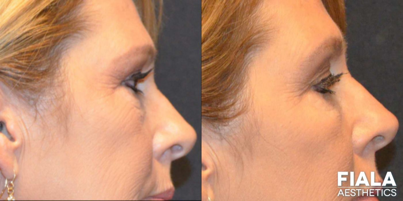 Before and after Dermal Fillers case 13939 - Angle 4