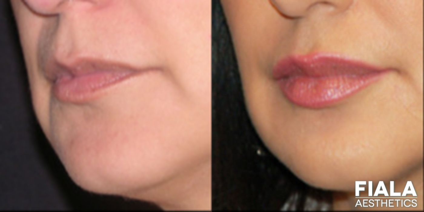 Before and after Dermal Fillers case 13926