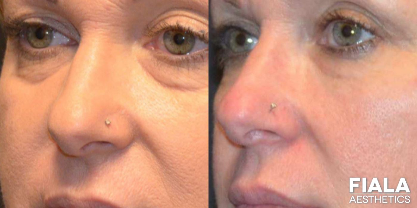 Before and after Dermal Fillers case 13936 - Angle 2