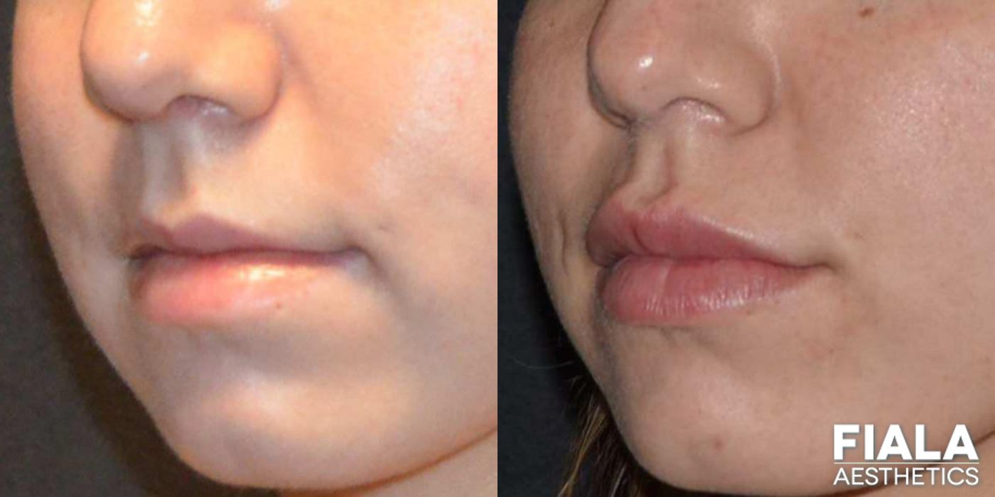 Before and after Dermal Fillers case 13937 - Angle 3