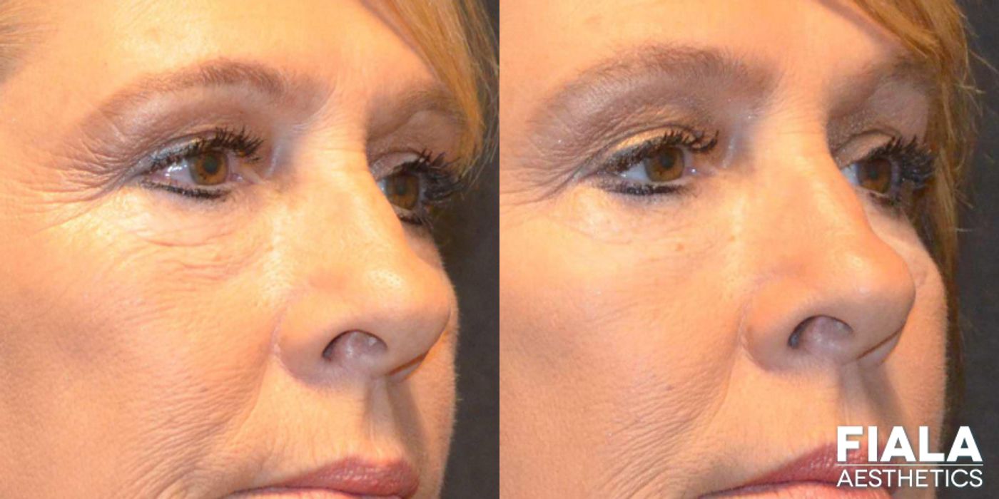 Before and after Dermal Fillers case 13939 - Angle 3