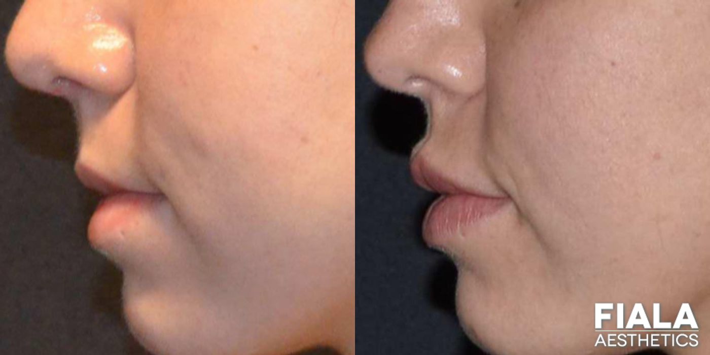 Before and after Dermal Fillers case 13937 - Angle 4