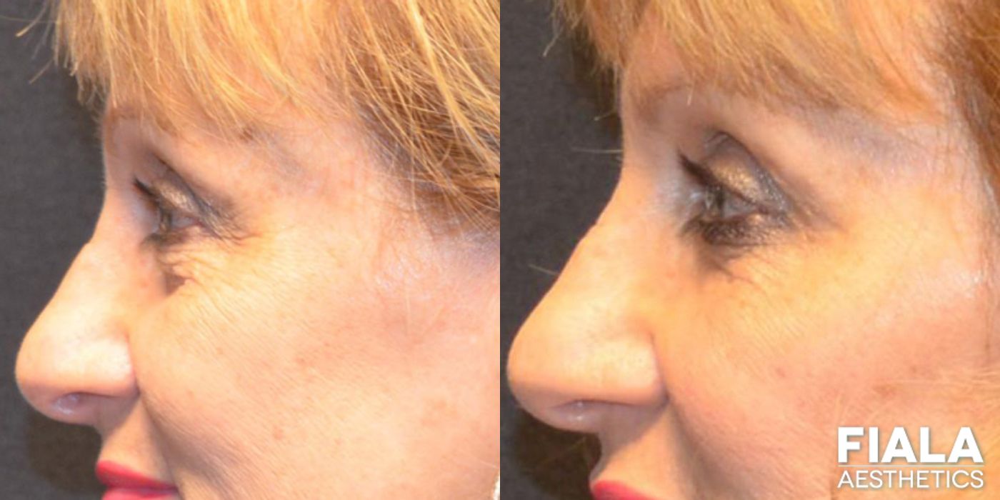 Before and after Dermal Fillers case 13932 - Angle 4