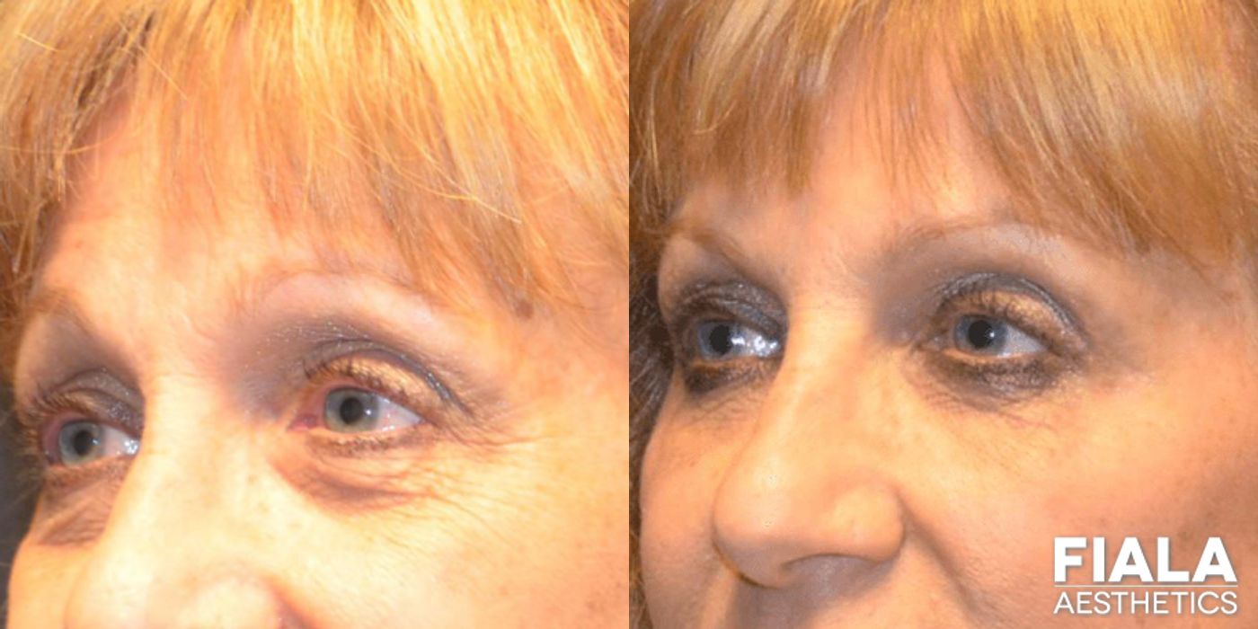 Before and after Dermal Fillers case 13932 - Angle 3