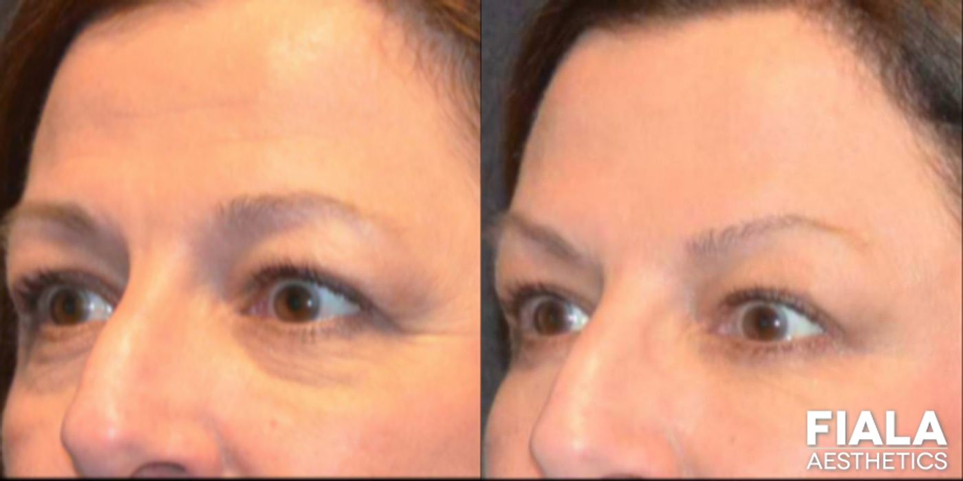 Before and after Dermal Fillers case 13933 - Angle 3