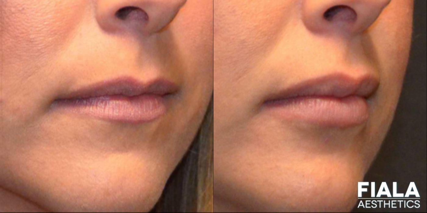 Before and after Dermal Fillers case 13938 - Angle 2