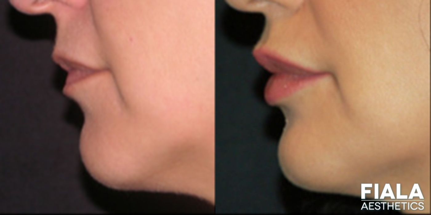 Before and after Dermal Fillers case 13926 - Angle 2