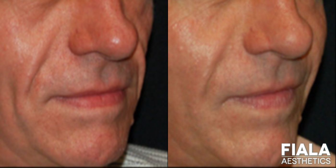 Before and after Dermal Fillers case 13927 - Angle 2