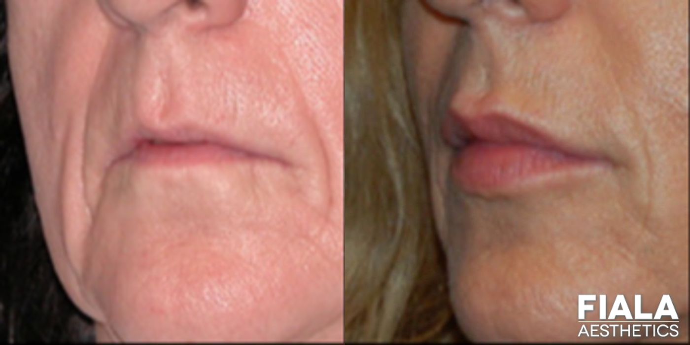 Before and after Dermal Fillers case 13930 - Angle 2