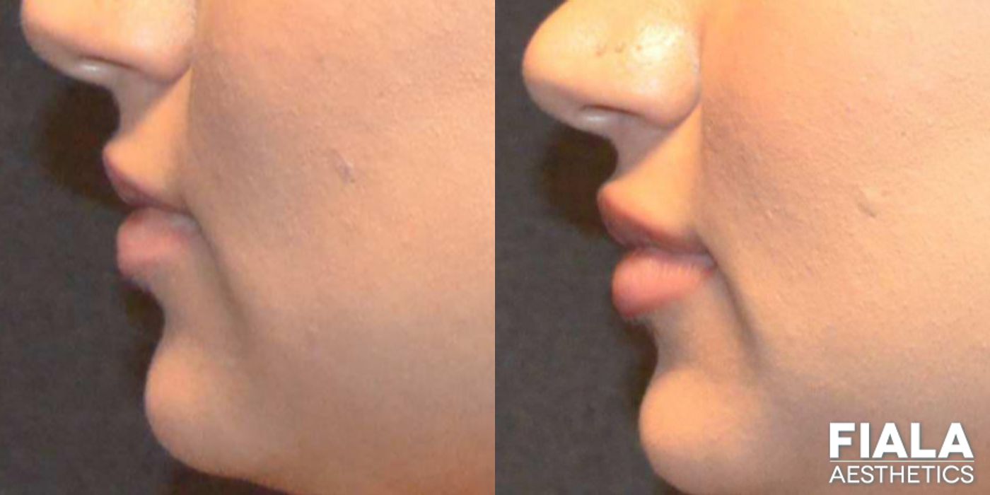 Before and after Dermal Fillers case 13941 - Angle 4