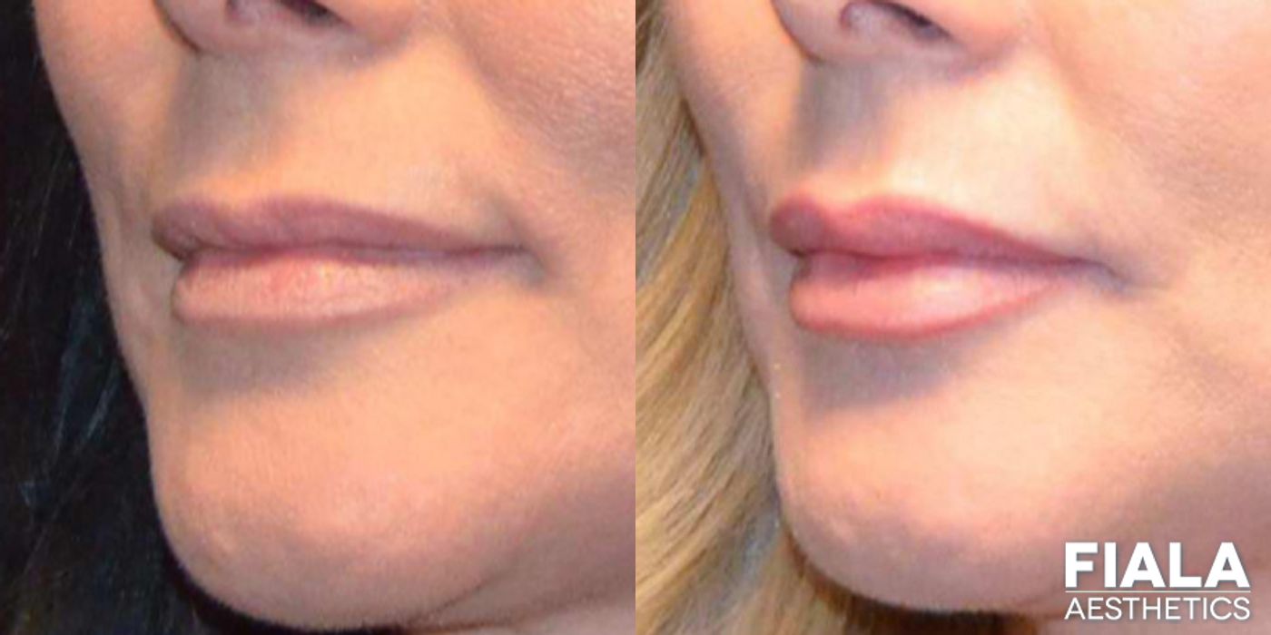 Before and after Dermal Fillers case 13940 - Angle 4