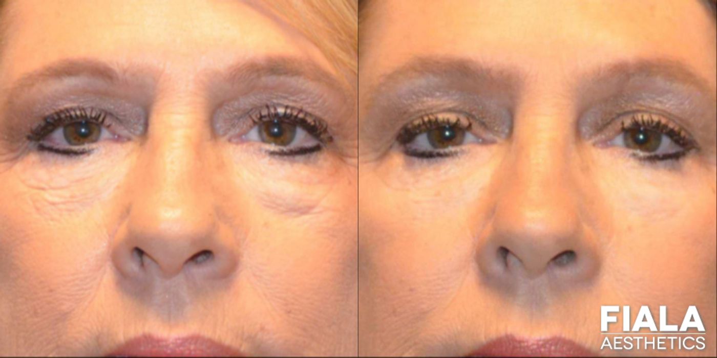 Before and after Dermal Fillers case 13939