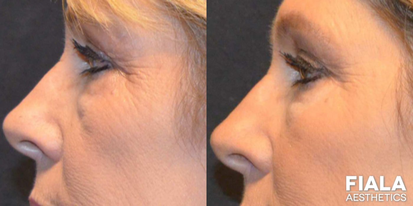 Before and after Dermal Fillers case 13939 - Angle 6