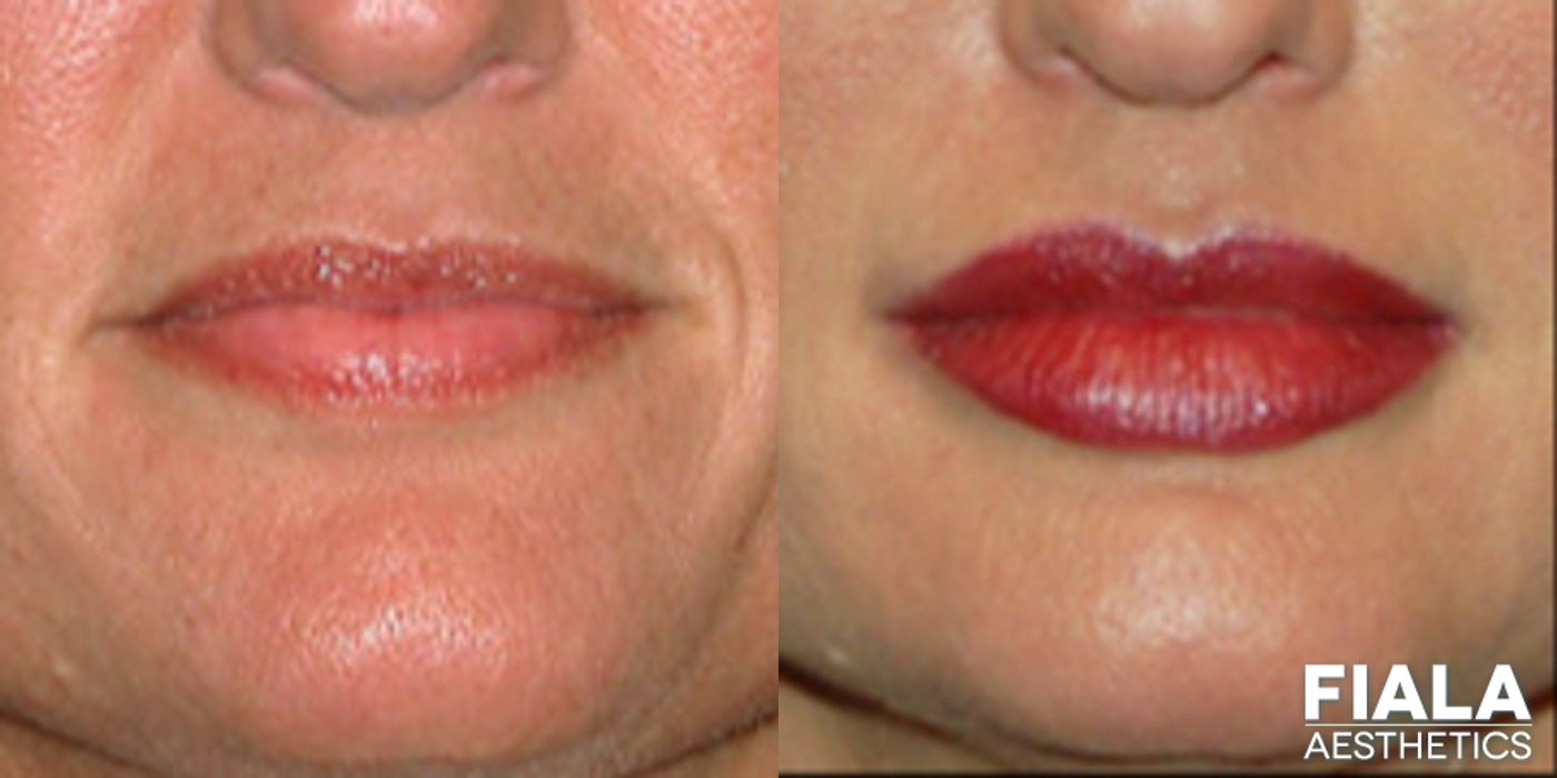 Before and after Dermal Fillers case 13924