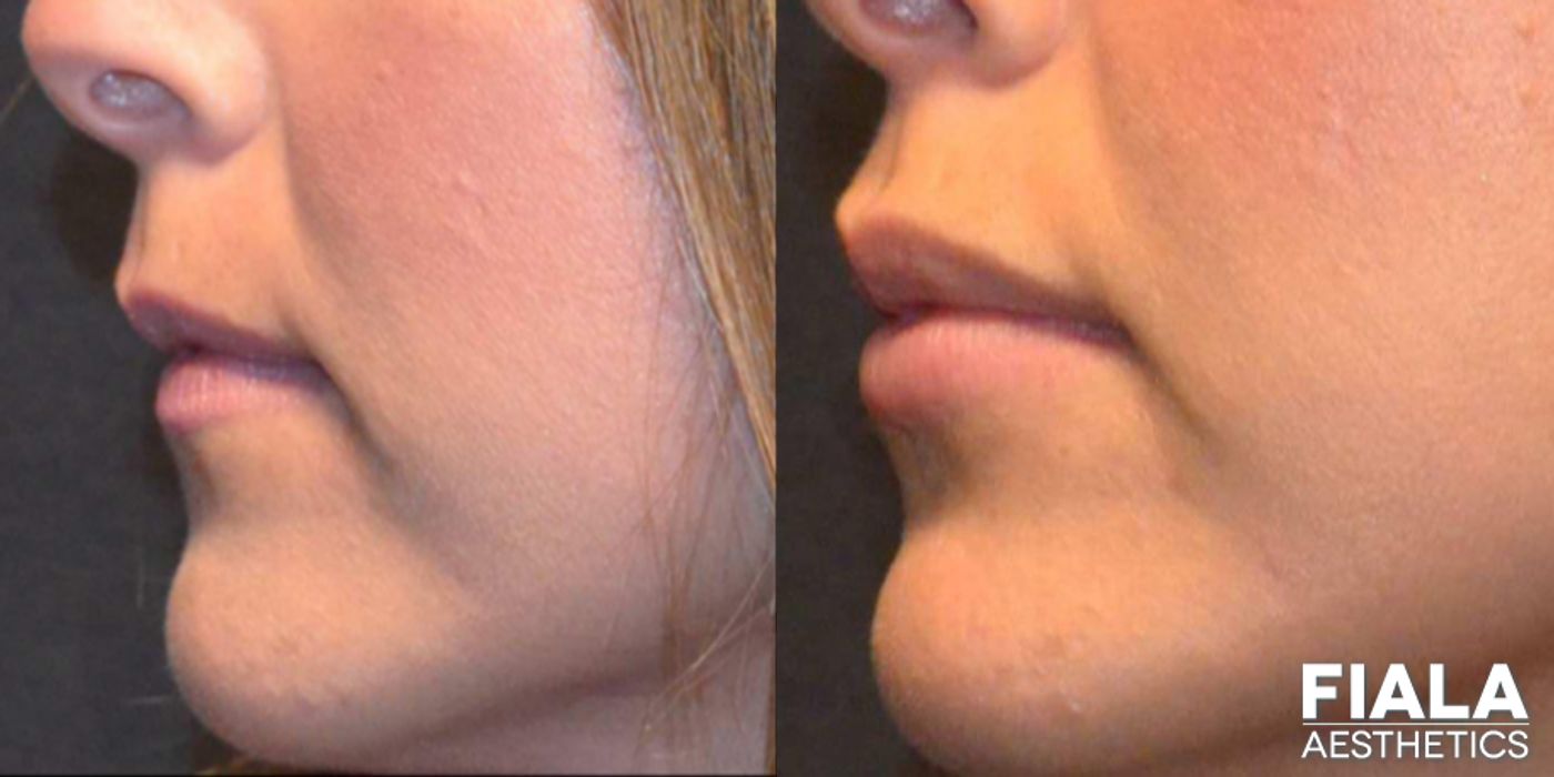 Before and after Dermal Fillers case 13938 - Angle 4