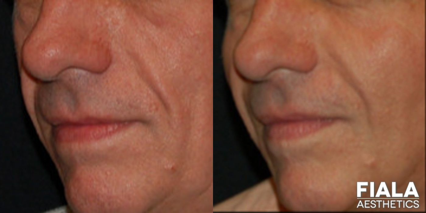 Before and after Dermal Fillers case 13929