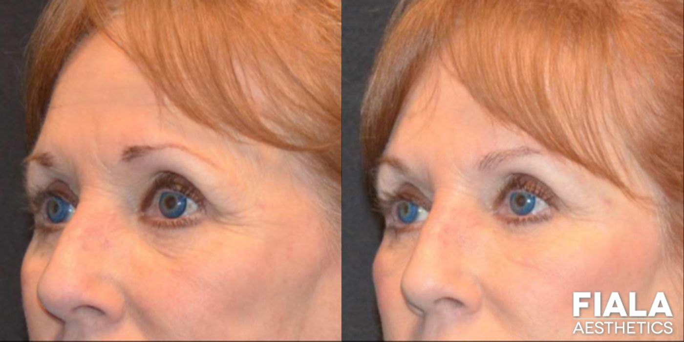 Before and after Dermal Fillers case 13935 - Angle 3